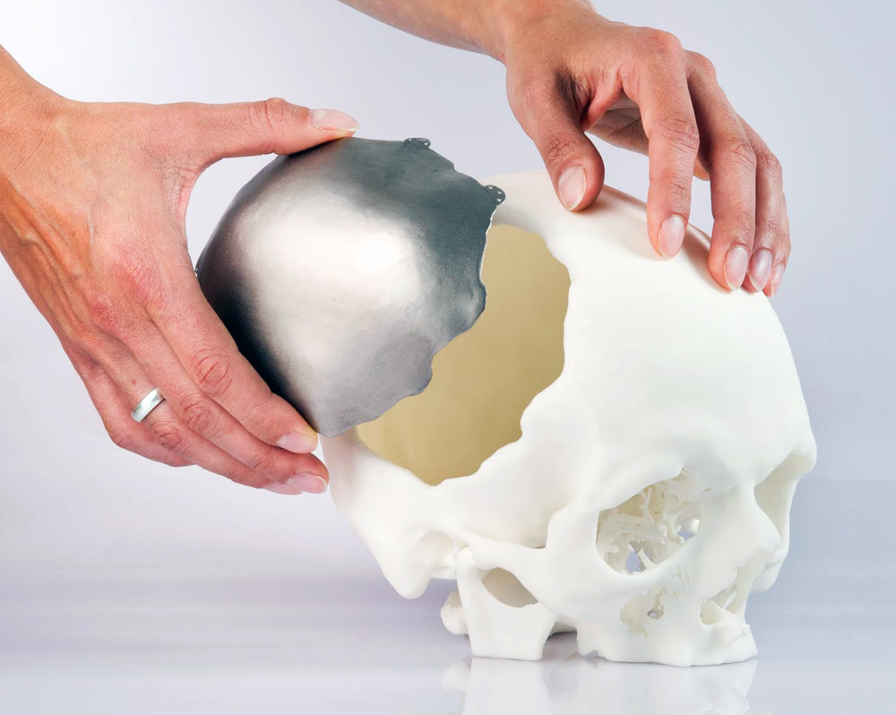 Cranial Implants Market