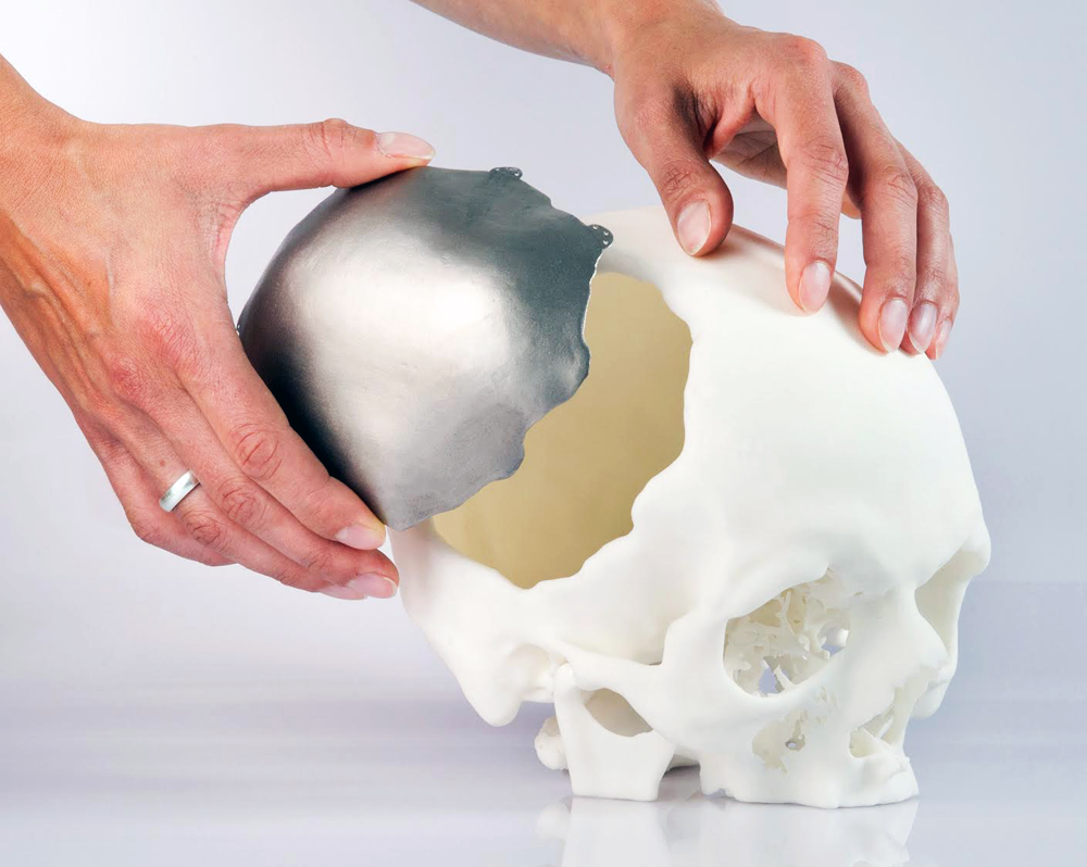 Cranial Implants Market'