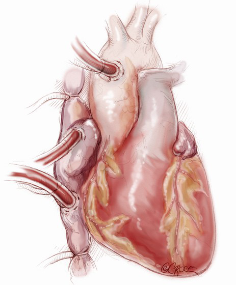 Total Artificial Heart Market'