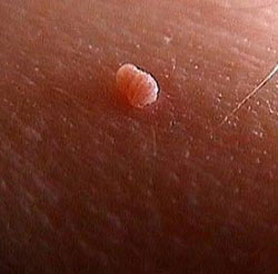 Skin Tag'