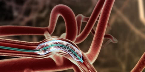 Intracranial Stents Market