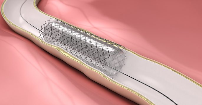 Vascular Stent Market'