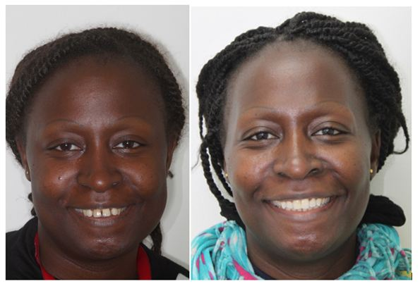 and After Invisalign Photo Courtesy of Dr Arman Barfeie