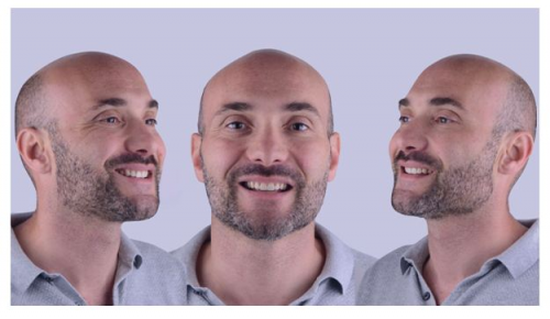 Smile Transformation by Dr Pedro Laranjeira Cosmetic Veneers'