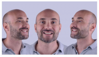 Smile Transformation by Dr Pedro Laranjeira Cosmetic Veneers