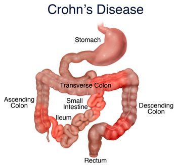 Crohn Disease Market'