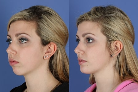 Facial Implants Market'