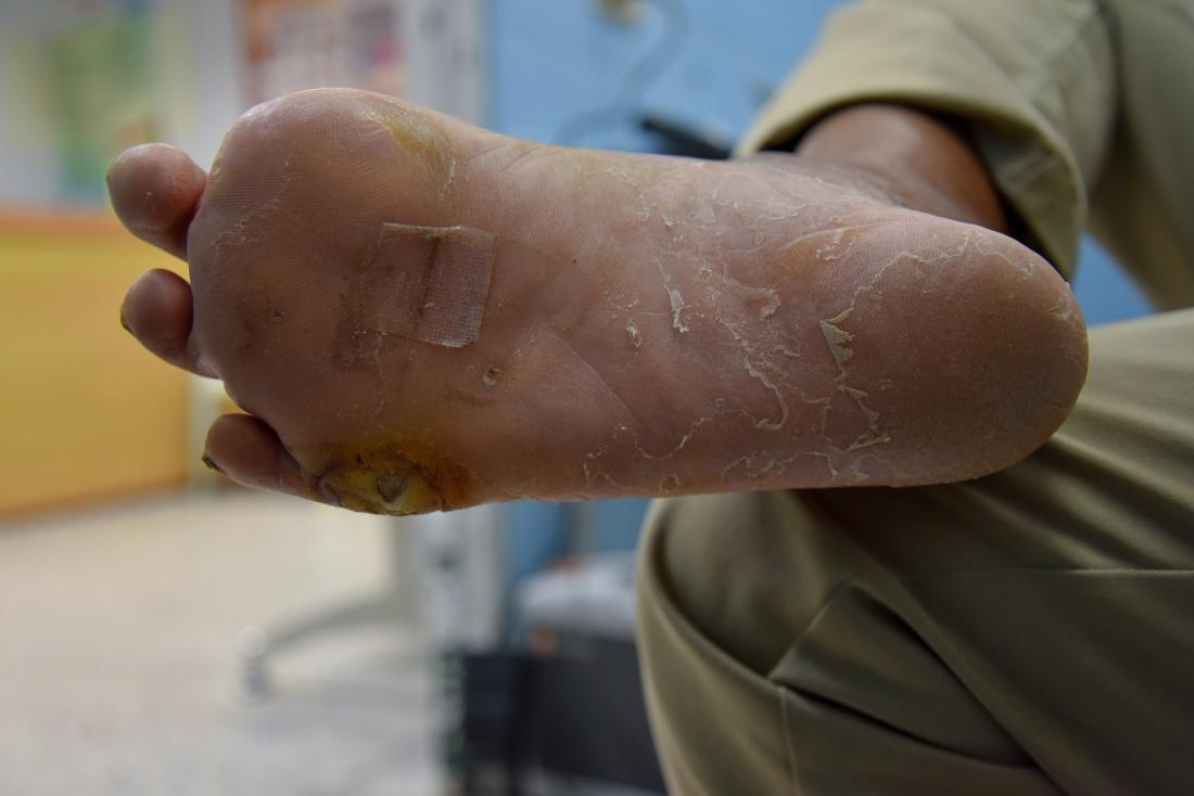 Diabetic Neuropathy Market
