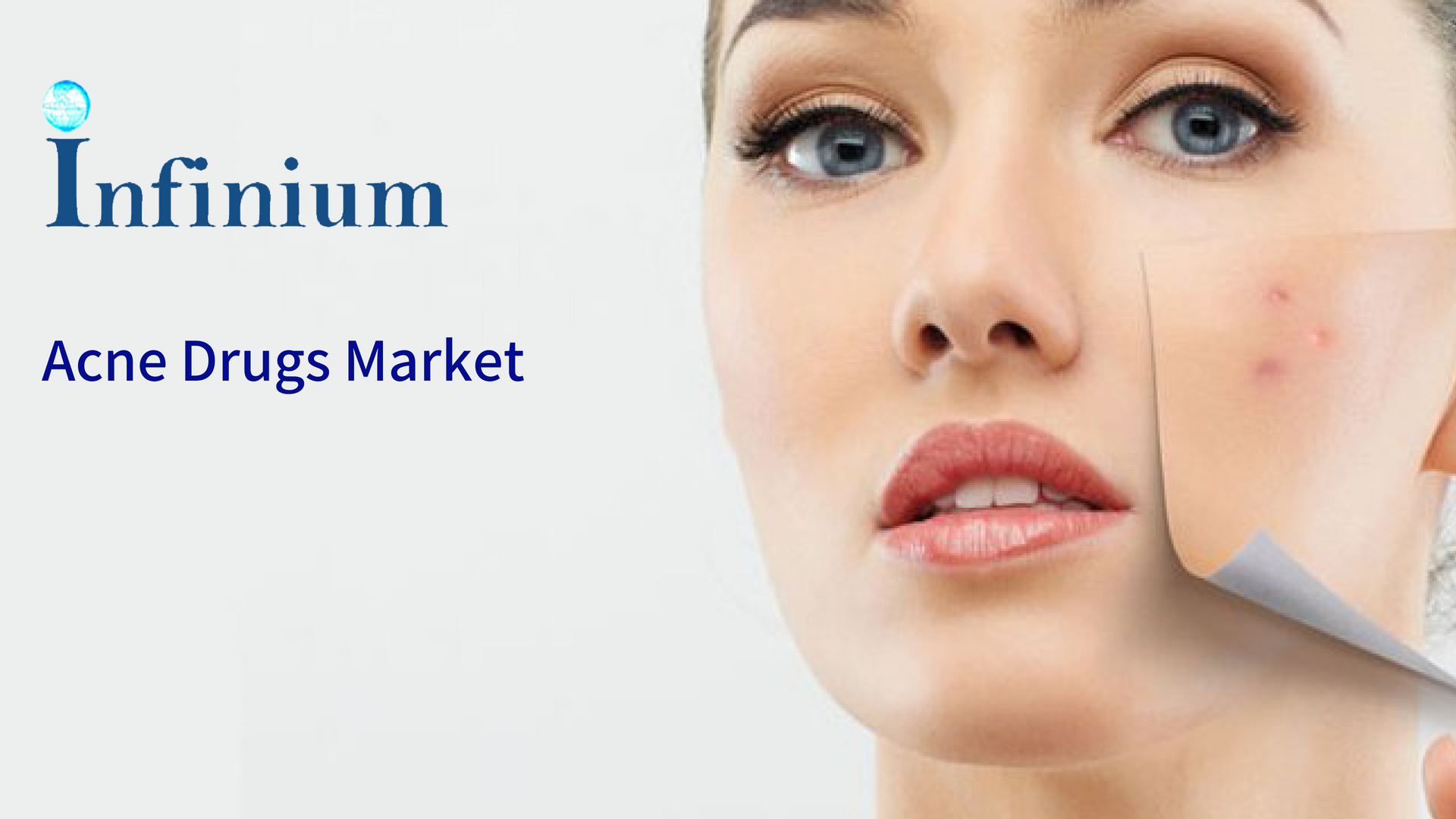 Acne Drugs Market