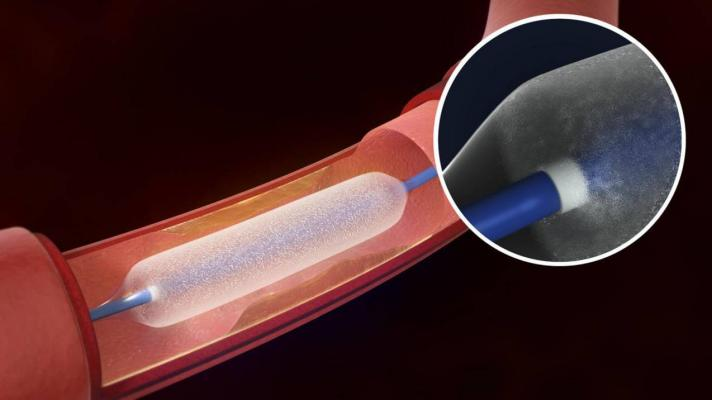 Drug Eluting Balloon Market