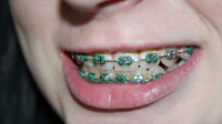 Torrance Orthodontist Is Providing Patients with Quality Ser