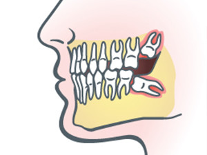 Dental Implants Washington'