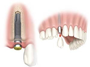 Dental Implants'