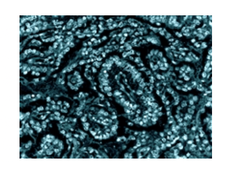 Molecular Photos Artwork - Yolk Sac Tumor