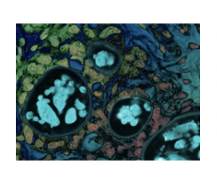 Molecular Photos Artwork - Clear Cell Carcinoma'