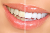 Teeth Whitening Sparks'