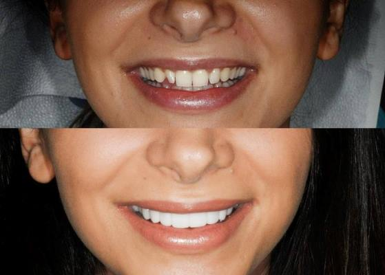 Smile Makeover'