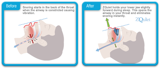 Zquiet how it works'