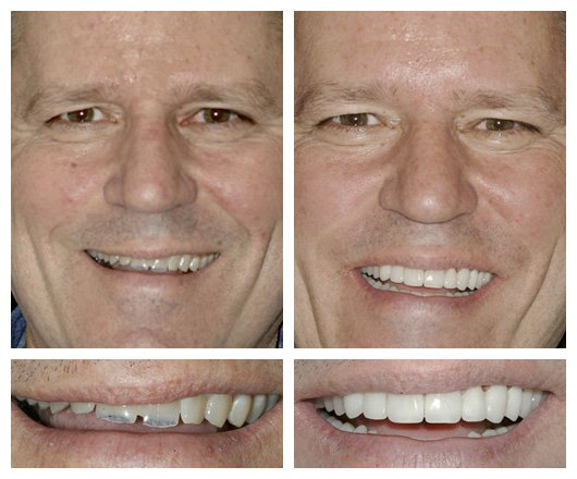 Dental Implants'