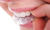 Teeth Whitening Service'
