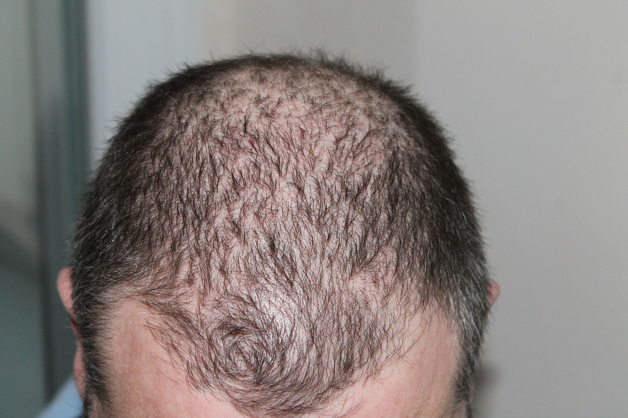 Gentera Reverses the Effects of Hair Loss with PRP and Nutra'