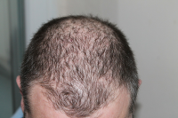 Gentera Reverses the Effects of Hair Loss with PRP and Nutra