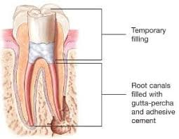 Root canal pain