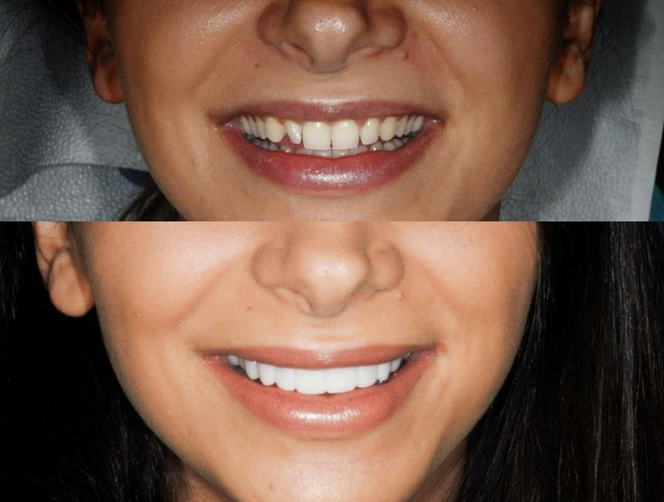 Smile Makeover by Sydney Dental Veneers'