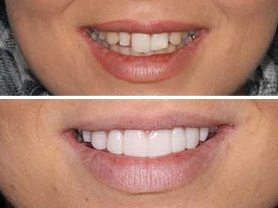 Smile Makeover by Sydney Dental Veneers'