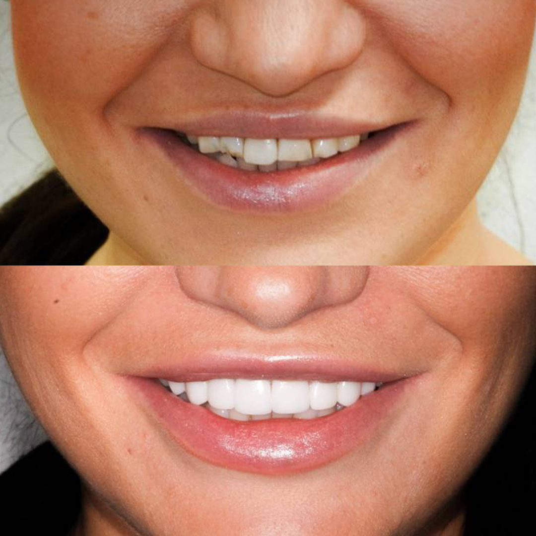 Sydney Dental Crowns'