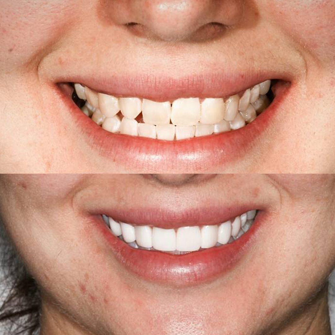 Sydney Dental Crowns'