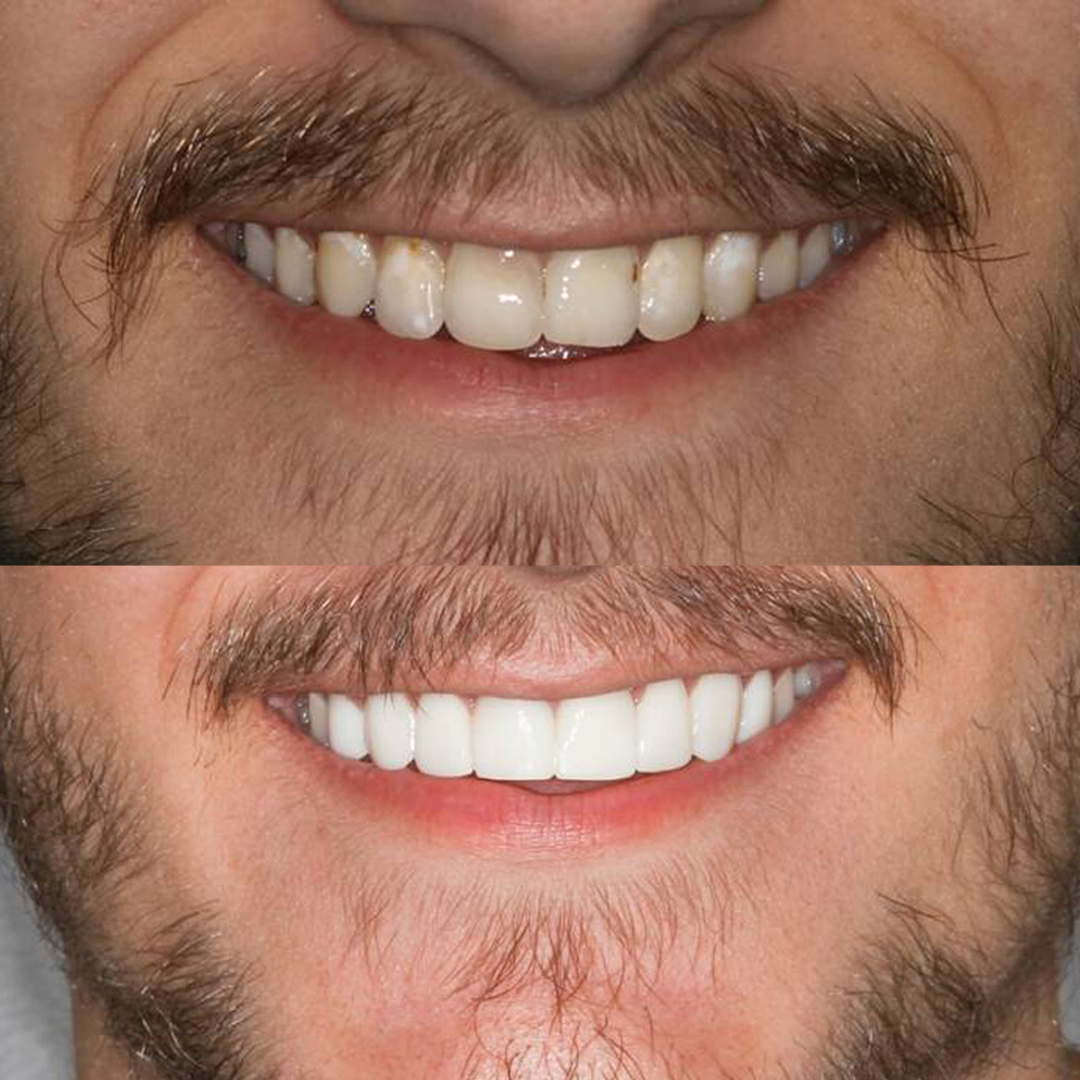 Sydney Dental Crowns'
