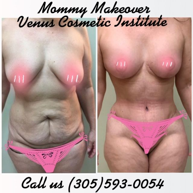 Abdominoplasty'