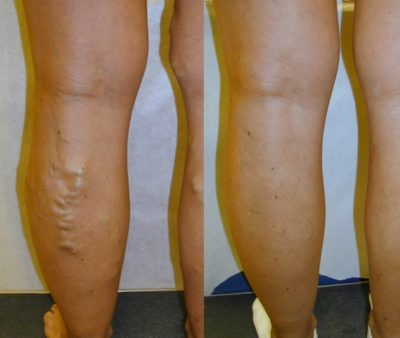 Reticular Veins CT'