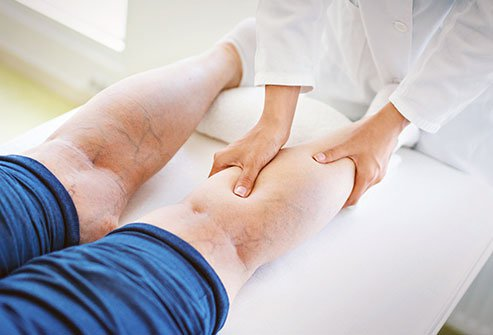 Varicose Veins San Diego'