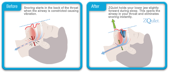 How the ZQuiet Works'