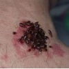 Bed Bug Exterminators'