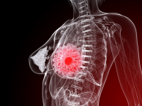 Metastatic Breast Cancer Treatment Market is Expected to Rea