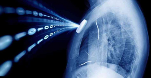 Implantable Medical Device Market is Expected to Reach USD 1'