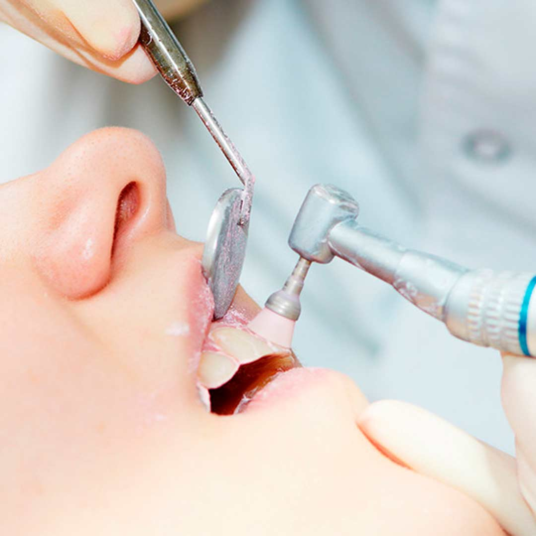 Dental Polishing Market: Global Product Intelligence Industr