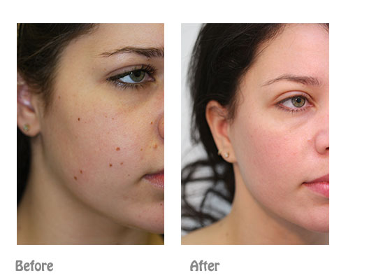 Skin Tag Removal Los Angeles'