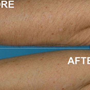 Stretch Mark Removal'