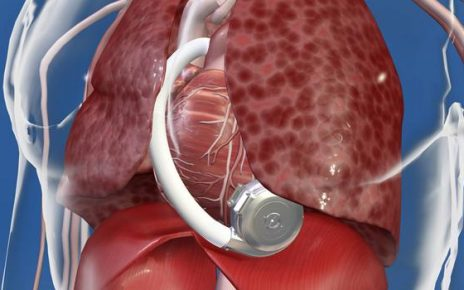 Smart Implantable Pumps Market