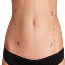 Breast Augmentation'