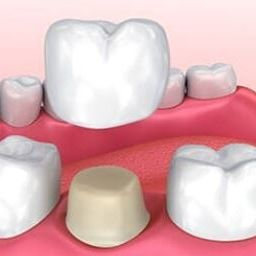 Dental Implants'