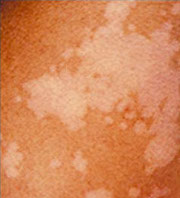 Tineaversicolor.us Reveals All Information about Skin Infect'