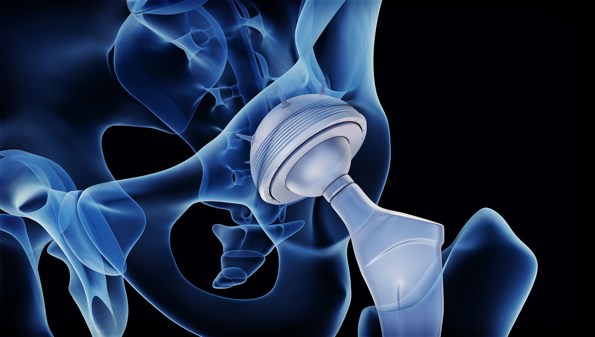 Artificial Joints Market'