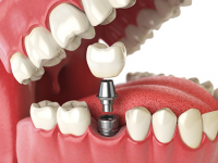 Dental Biomaterials Market