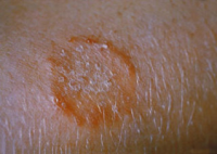 Get the Latest to Treat Ringworm Diseases from the Experts