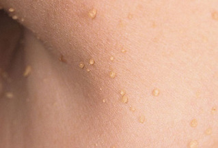 Providing Expert Skin Tag Removal Information'